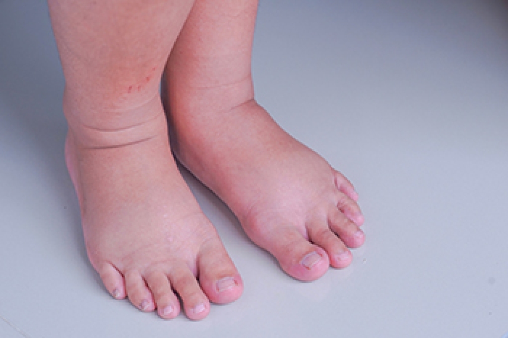 Causes of Swollen Feet During Pregnancy