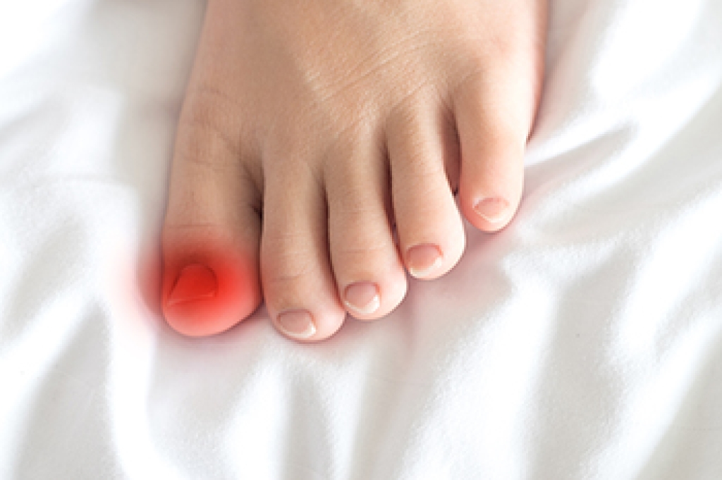 Managing and Preventing Ingrown Toenails