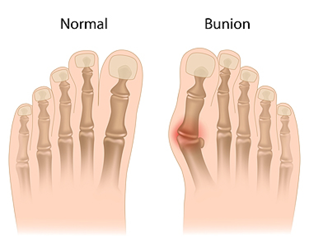 Understanding Bunions and Their Causes