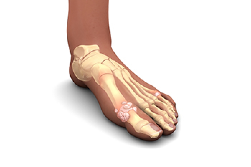 Gout Symptoms and Possible Food Triggers