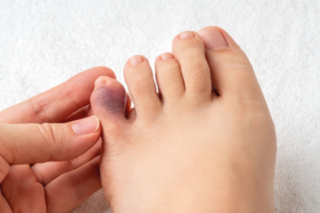 Broken Toe Symptoms and Treatment
