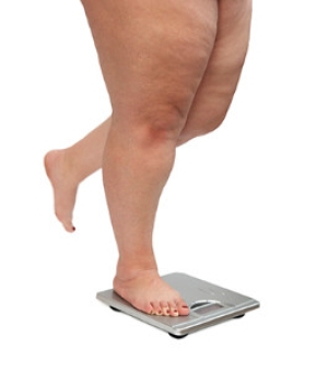 Obesity and Plantar Fasciitis